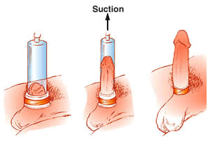 may tap duong vat gia re penis pump 6